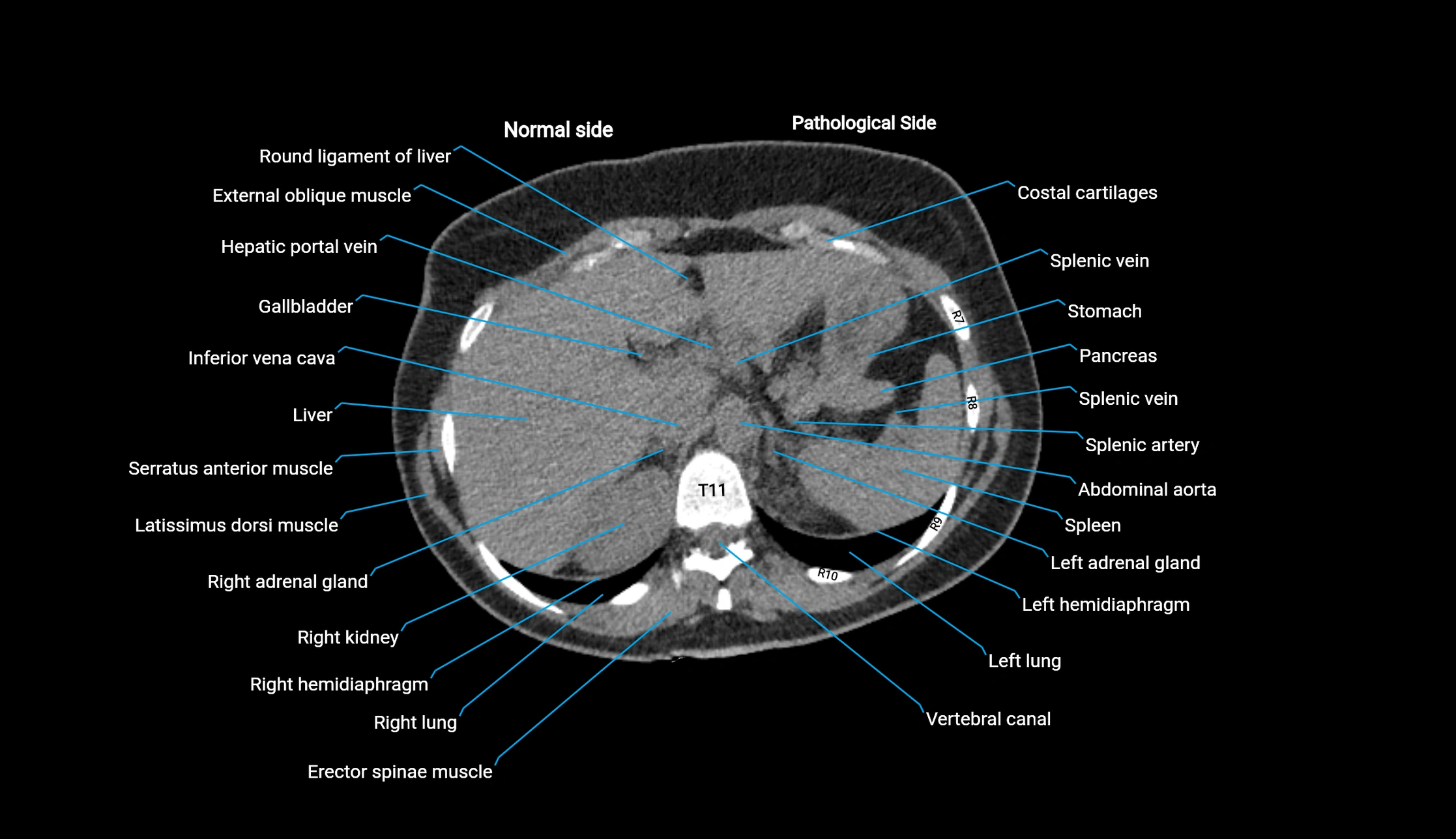 CT KUB axial cross sectional anatomy  radiology image -img-00201-00016.webp